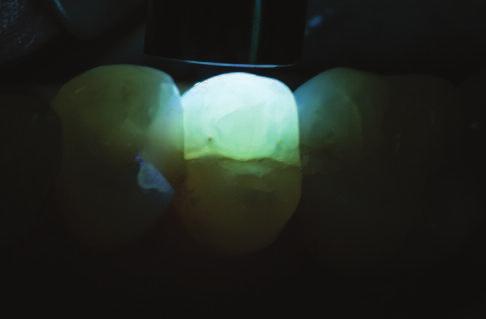 Deep cracks that extend over dentin will block the transmission of the light (Figure 12a), while surface enamel cracks will not block the transmission (Figure 12b).