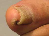 These can also feel painful and appear red and inflamed. Thickened nails - nails that are growing thickly and causing pain.