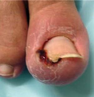 Figure 1. Infected ingrown toenail.