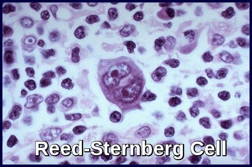 LYMPHOMA THIRD MOST COMMON TYPE Hodgkin: The Reed Sternberg Cell- 41% of all.
