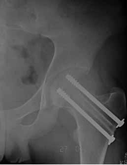 necrosis and nonunion. Osteotomy results in a shorter limb and mechanically unsound hip.