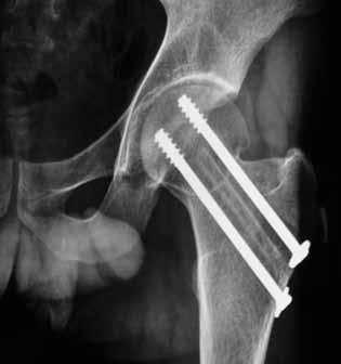 femoral neck fractures.