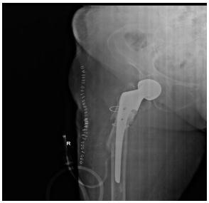 7%) occurred after two months of surgery and was treated with plating. In Bipolar prosthesis group, one case of introperative fracture (6.7%) occurred and treated with stainless steel wire encirclage.