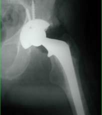 DISPLACED FNFX ELDERLY ARTHROPLASTY OFFERS LOWER REOPERATION RATE