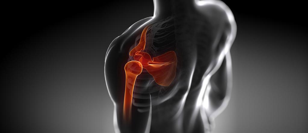 WHAT IS A TOTAL SHOULDER REPLACEMENT?