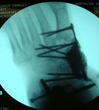2nd stage reconstruction of mid-foot was performed eight weeks after ankle
