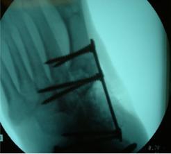Bone resection arthrodesis via locking plate.