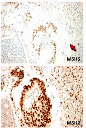 Germline (Lynch syndrome) and/or sporadic mutations Epigenetic silencing (MLH1