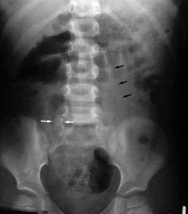 Supine anteroposterior abdominal radiograph shows a calcified appendicolith (white arrows) in the right lower quadrant.