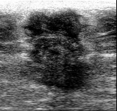 malignancy in men. Male breast cancers have similar Sonographic features as in females except for Papillary carcinomas, which presents as a prominent cystic component in males as compared to females.