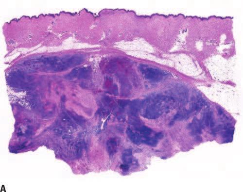788 SECTION 4 NEURAL TUMORS HISTOPATHOLOGIC CHARACTERISTICS At low magnification, MPNST presents as an ill-defined neoplasm that deeply infiltrates subcutaneous fat and adjacent soft tissues.