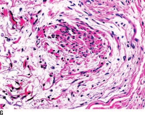 A: Panoramic view showing an infiltrating neoplasm