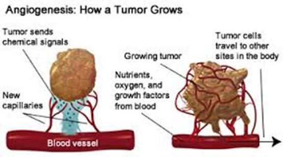 Definition of Cancer Development of abnormal cells that divide uncontrollably and have the ability to
