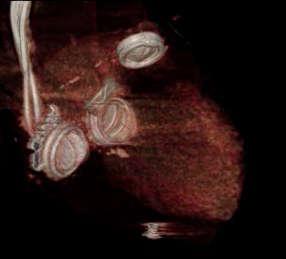 Evolving applications Myocardial perfusion CT 4D evaluation of prosthetic heart valves Clinical