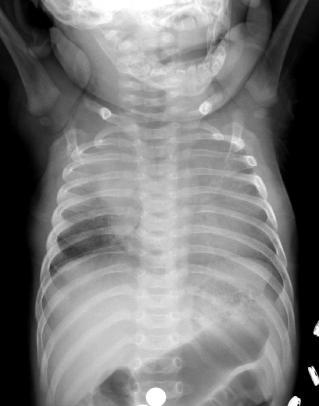 Back To Our 8-Month-Old Male 8 months after initial hospitalization the child had external fixators placed to try to promote