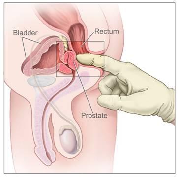 What is PSA? PSA, which stands for prostate specific antigen, is a protein made only in the prostate and not elsewhere in the body.