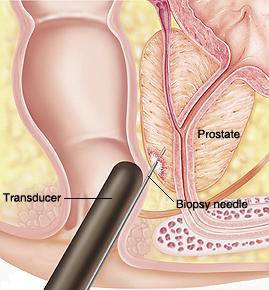 As many as 16 or more biopsies of the prostate are taken. These core samples are almost an inch long and extend from the back of the prostate through to the front.