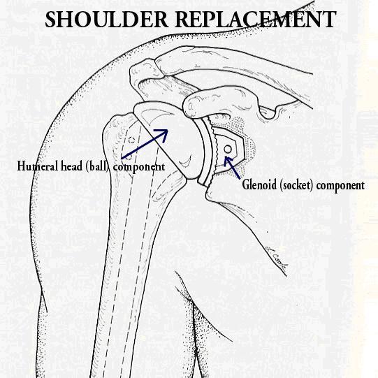 A diagram of an anatomic shoulder replacement the plastic socket replaces the