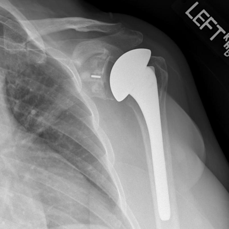Operative For patients with continued pain and poor function, reverse shoulder arthroplasty is an option. Care for patients with massive rotator cuff tears is complex and require specialized care.