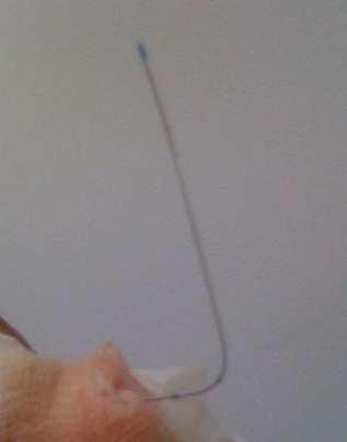 Position of the catheter on the right, after extraction