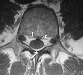 The median septum is clearly visible (arrow), dividing the epidural space into two separate compartments