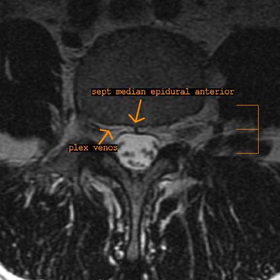 Axial MRI section T1 and T2 through a lombar vertebra at the pediculolamar level.