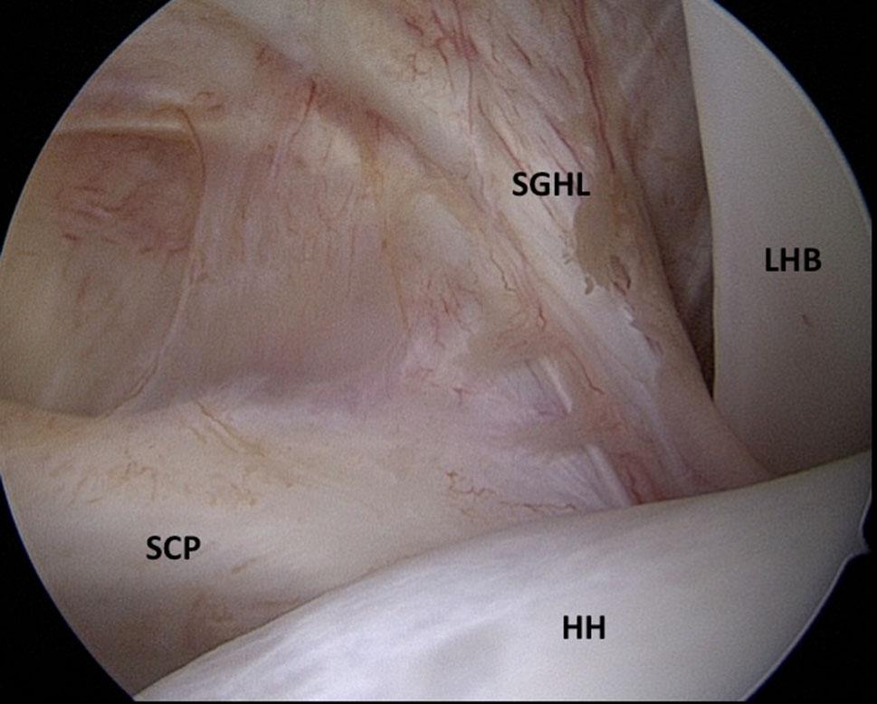 1098 Arch Orthop Trauma Surg (2017) 137:1097 1105 ligament (CHL), in stabilizing the intra-articular part of the LHB [6]. Previously, Werner et al.