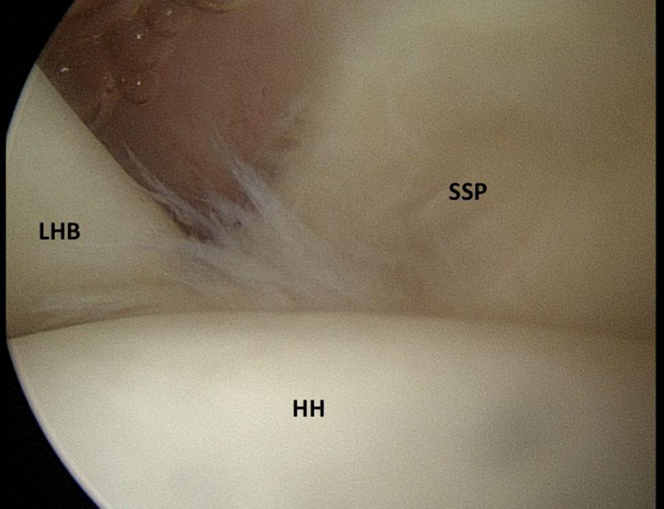 ligament (CHL) Fig. 6 Arthoscopic view from posterior portal showing pulley lesion grade 3 with partial tear of SCP lesions in both primary and revision rotator cuff treatments.