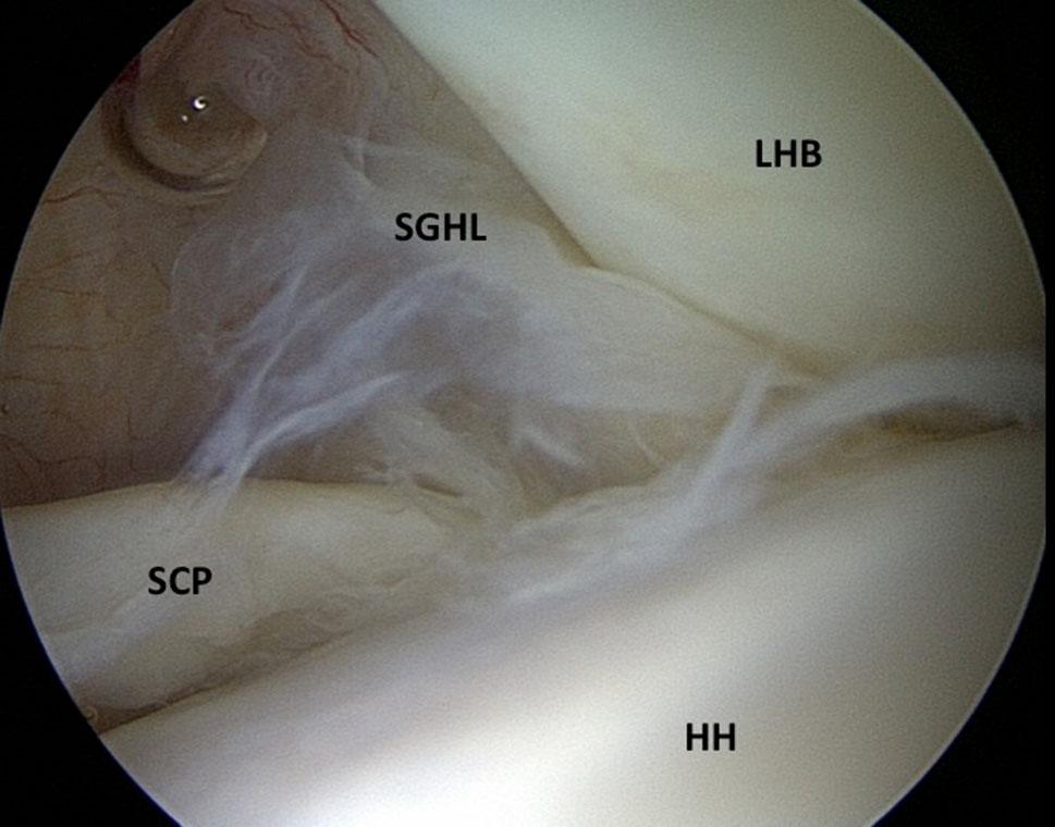 5 Arthoscopic view from posterior portal showing pulley lesion grade 2 with partial tear of SSP observed an association with superior labrum anterior posterior (SLAP) lesions, in a prospective