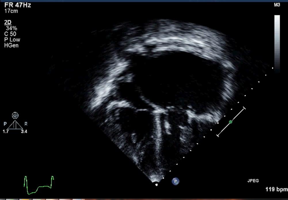 PV 119 bpm Figure 2: Normal off-setting atrioventricular valves. Large left atrium () with inter atrial septum to the right.