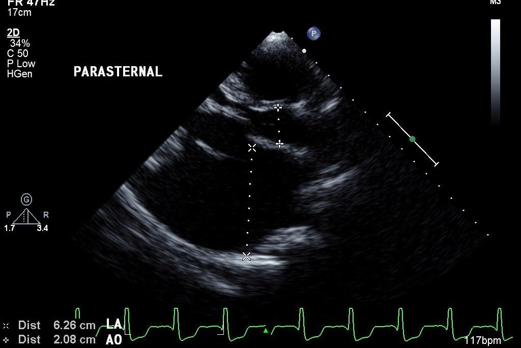 Reversal of flow in left pulmonary veins. PASTERNAL AO A0 Dist Dist 6.26cm 2.