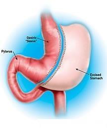 RESTRICTIVE Sleeve Gastrectomy Stomach reduced to 20-25% of original size Surgical removal of large portion of stomach