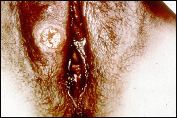 What are the Symptoms of Syphilis?