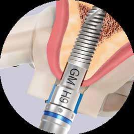 3.3. GM NGS Connections Neodent GM implants were developed to begin placement with contra-angle or manually, and finished with the torque wrench.