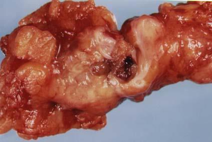 confusing Duct papilloma serous or