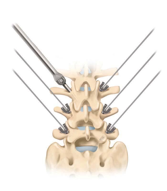 10 Dynesys Top-Loading System Surgical Technique Placement of the Pedicle Screws Place desired screw and Pedicle Screw Driver over K-wire.