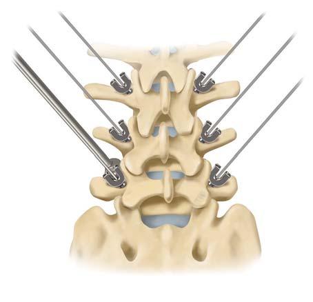 Advance into the pedicle until the screw head or the polished portion of the screw is in contact with the bone.