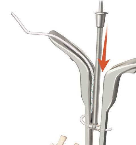 22 Dynesys Top-Loading System Surgical Technique Ensure that a minimum of 20 mm of Functional Zone extends beyond the