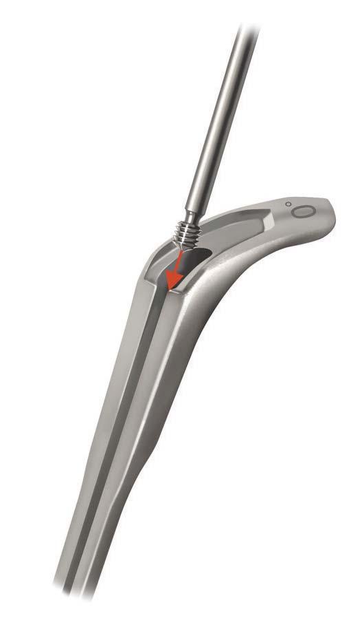 24 Dynesys Top-Loading System Surgical Technique Placing and Tightening the First Set Screw with the 0 Dynesys Glide Instrument Reposition the cord as required, ensuring that a minimum of 10 mm