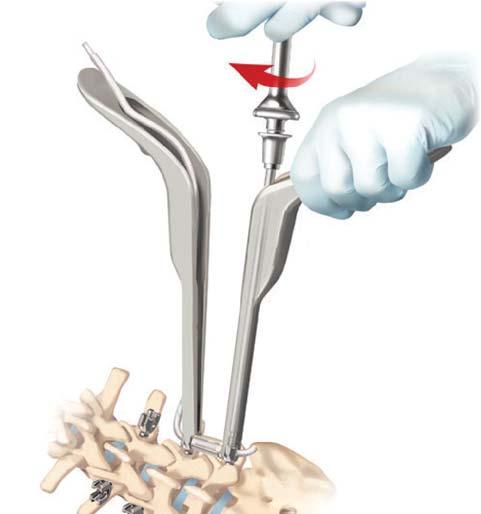 Remove the Set Screw Driver assembly and 0 Dynesys Glide Instrument. Note: It may be necessary to compensate for tissue pressure when removing the 0 Dynesys Glide Instrument.