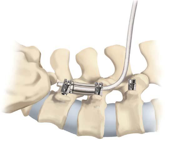 32 Dynesys Top-Loading System Surgical Technique Repeat Contralateral Side Adjacent Segment(s) Refer to the Dynesys Glide Instrumentation: