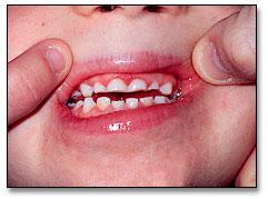 Oral Health Needs for CSHCN Children with developmental delay or autism may have damaging oral habits such as: bruxism food pouching mouth