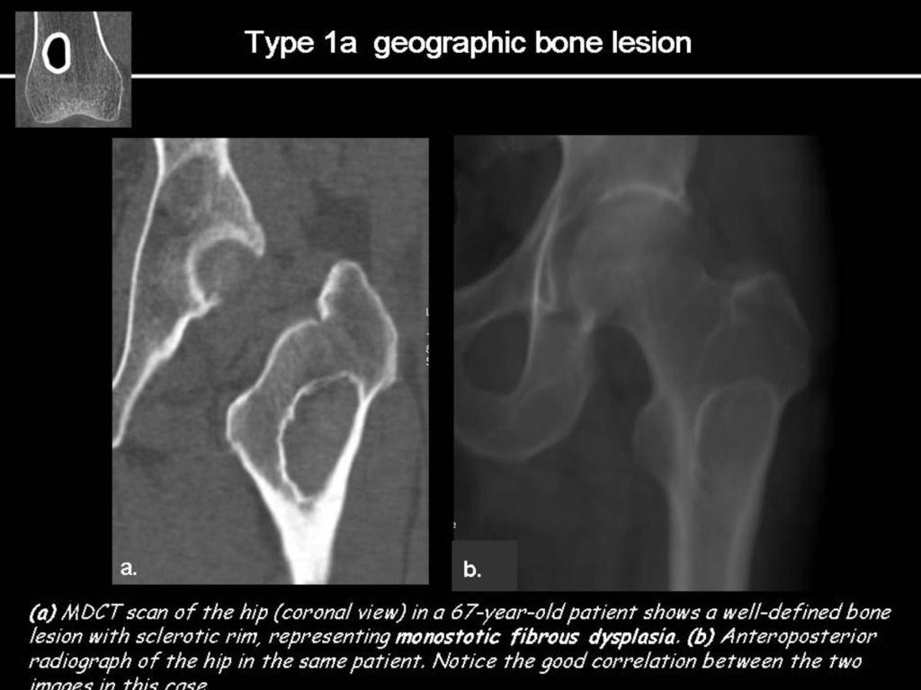 Fig.: Type 1a geographic lesion.