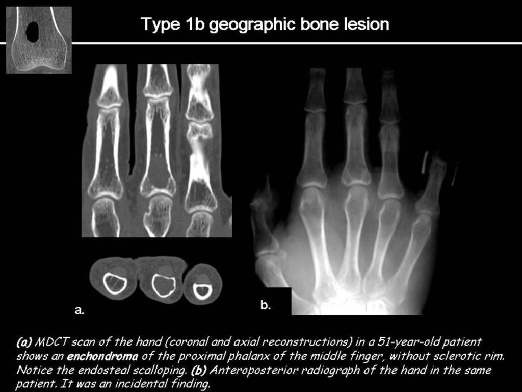 Fig.: Type 1b geographic bone lesion. - type Ic (ill-defined margins), usually malignant moth-eaten destruction (type II): multiple clustered foci of bone destruction, each one 2-5 mm size.