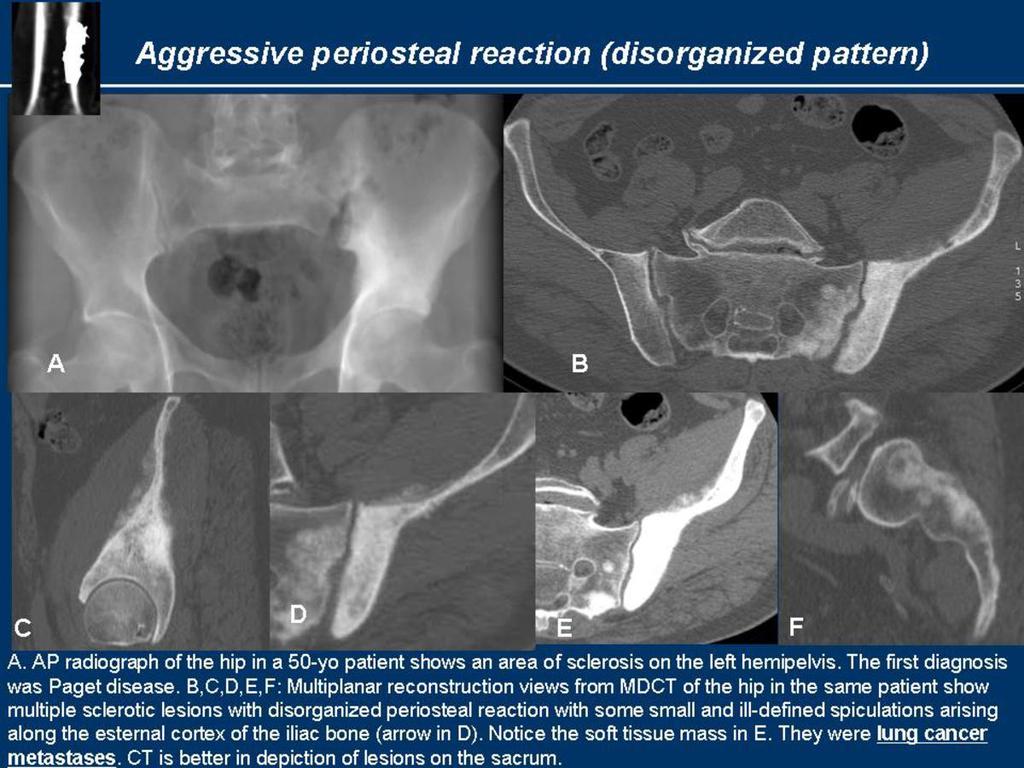 Fig.: Aggressive periosteal reaction (lung cancer metastases) - Codman triangle: It is an aggressive form that develops when a portion of periosteum is