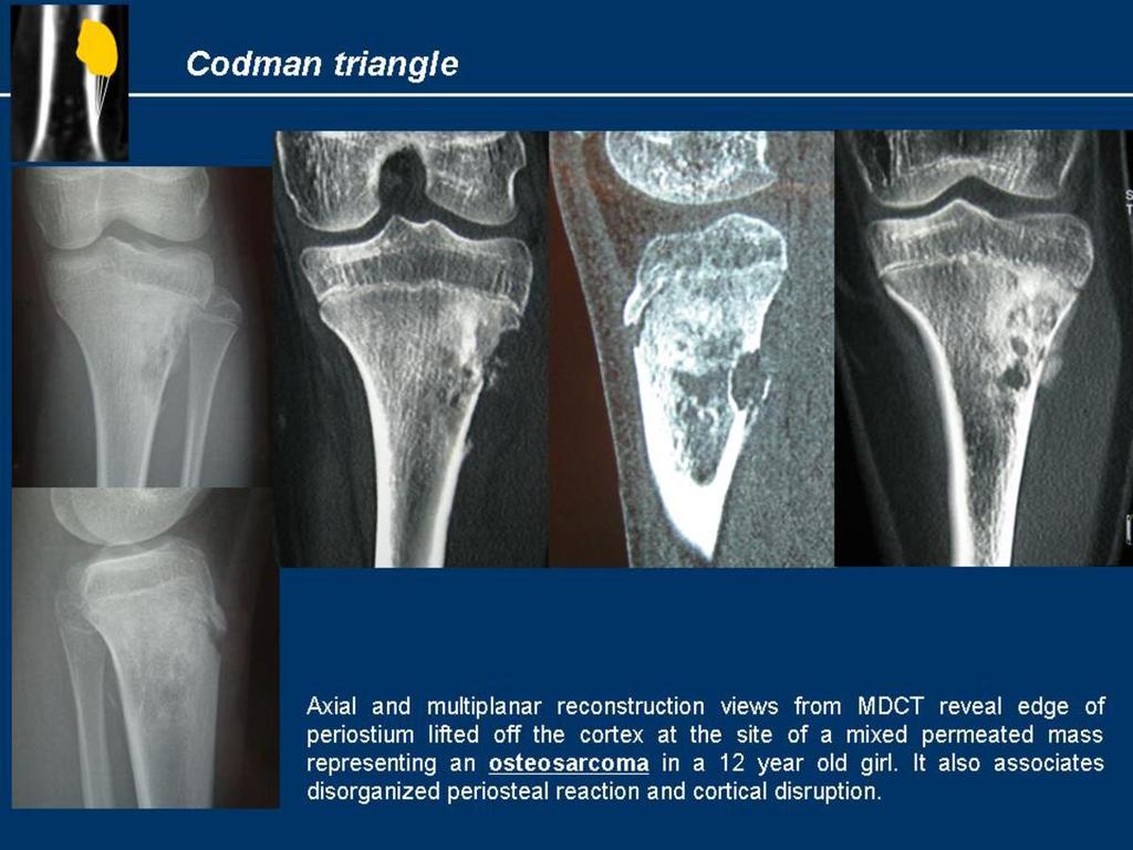 Fig.: Codman triangle in osteosarcoma.