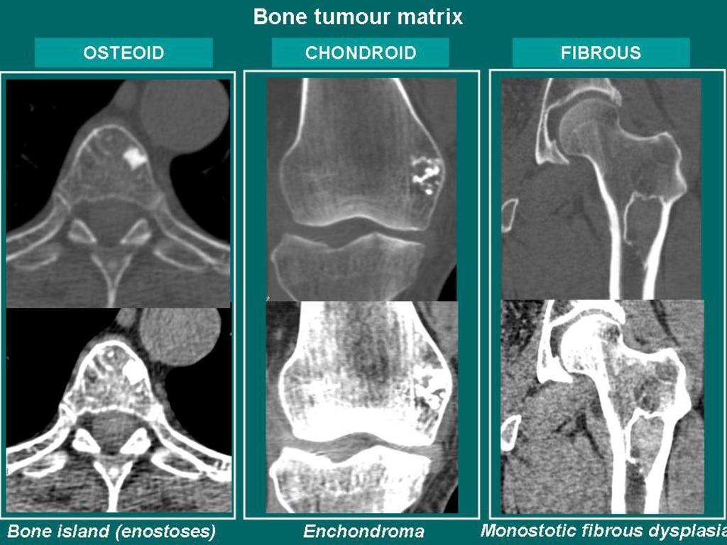 Fig.: Types of tumor matrix.