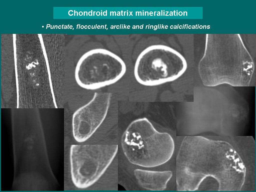 - Chondroid matrix shows punctate, flocculent, arclike or ringlike calcifications. Malignant transformation within a chondral lesion may produce focal destruction of the chondral calcifications. Fig.