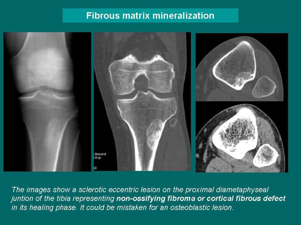 Fig.: Fibrous matrix tumor Faint mineralization in a lession is best assesed using CT, which is mores sensitive than radiographs for di
