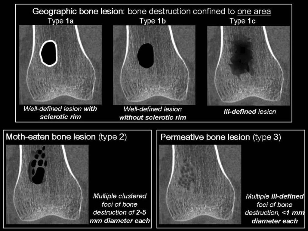 a. Patterns of bone destruction: They reflect the growth rate rather than the malignant potential of the lesion.